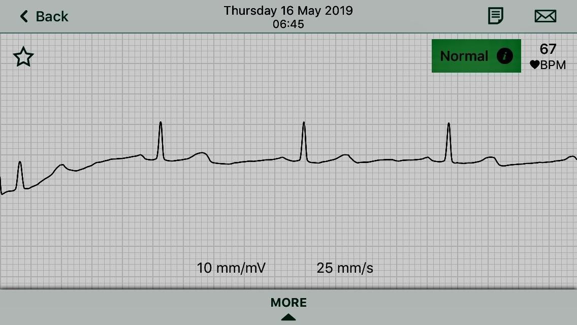 KardiaMobile 1-Lead EKG Monitor Medical-Grade FDA-Cleared Personal Heart Monitor Detects AFib & Arrhythmias 30 Second Results Works with Most Smartphones