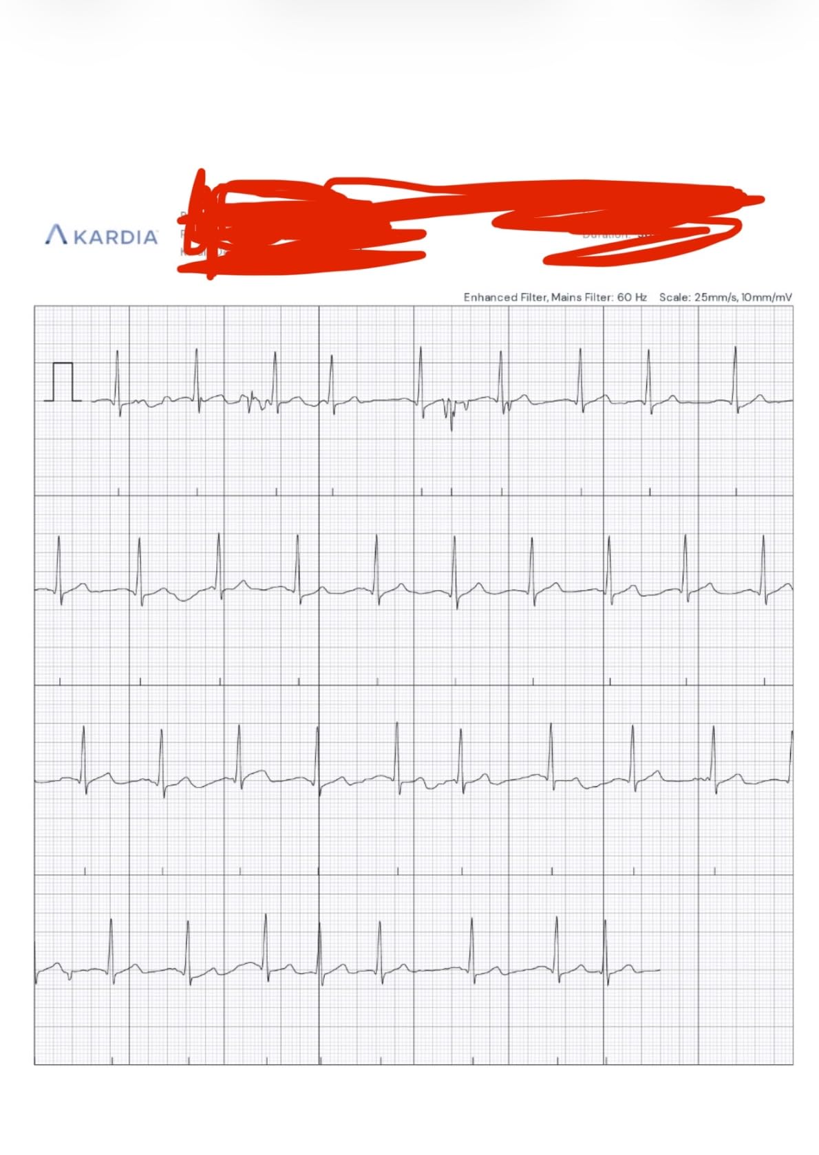 KardiaMobile 1-Lead EKG Monitor Medical-Grade FDA-Cleared Personal Heart Monitor Detects AFib & Arrhythmias 30 Second Results Works with Most Smartphones